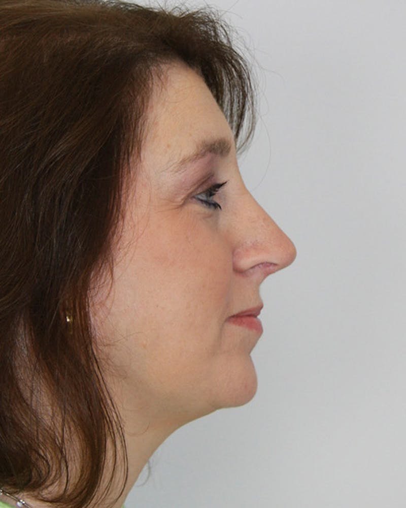 Rhinoplasty Before & After Gallery - Patient 143522100 - Image 6