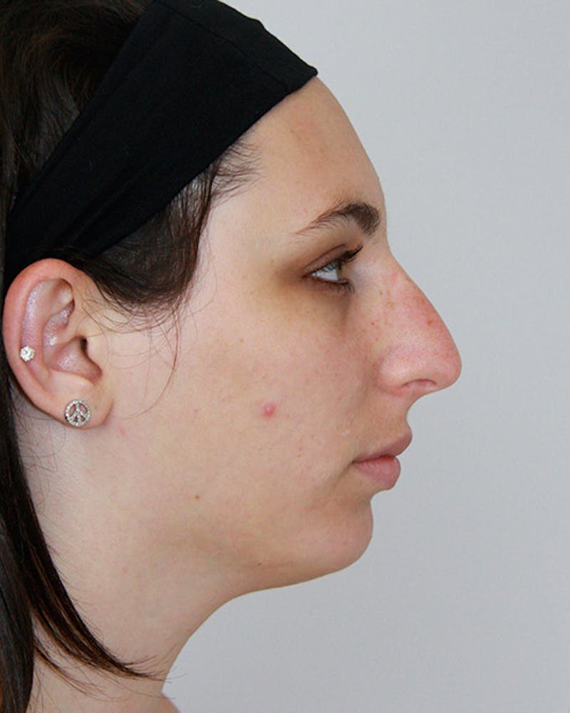 Rhinoplasty Before & After Gallery - Patient 143522116 - Image 1