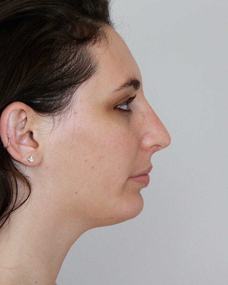 Rhinoplasty Before & After Gallery - Patient 143522116 - Image 2