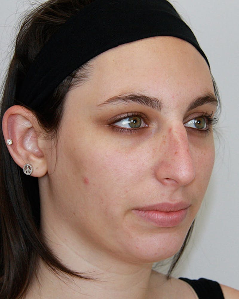 Rhinoplasty Before & After Gallery - Patient 143522116 - Image 3