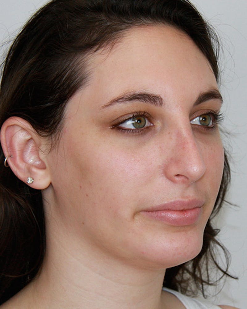 Rhinoplasty Before & After Gallery - Patient 143522116 - Image 4