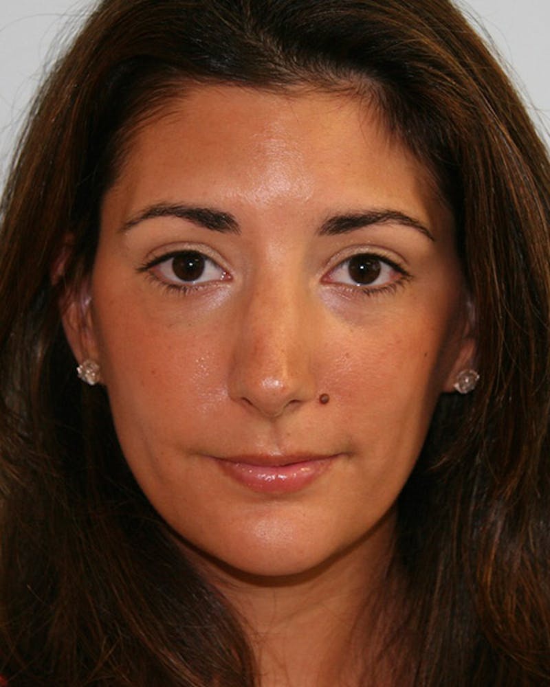 Rhinoplasty Before & After Gallery - Patient 143522118 - Image 1