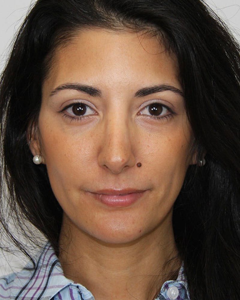 Rhinoplasty Before & After Gallery - Patient 143522118 - Image 2