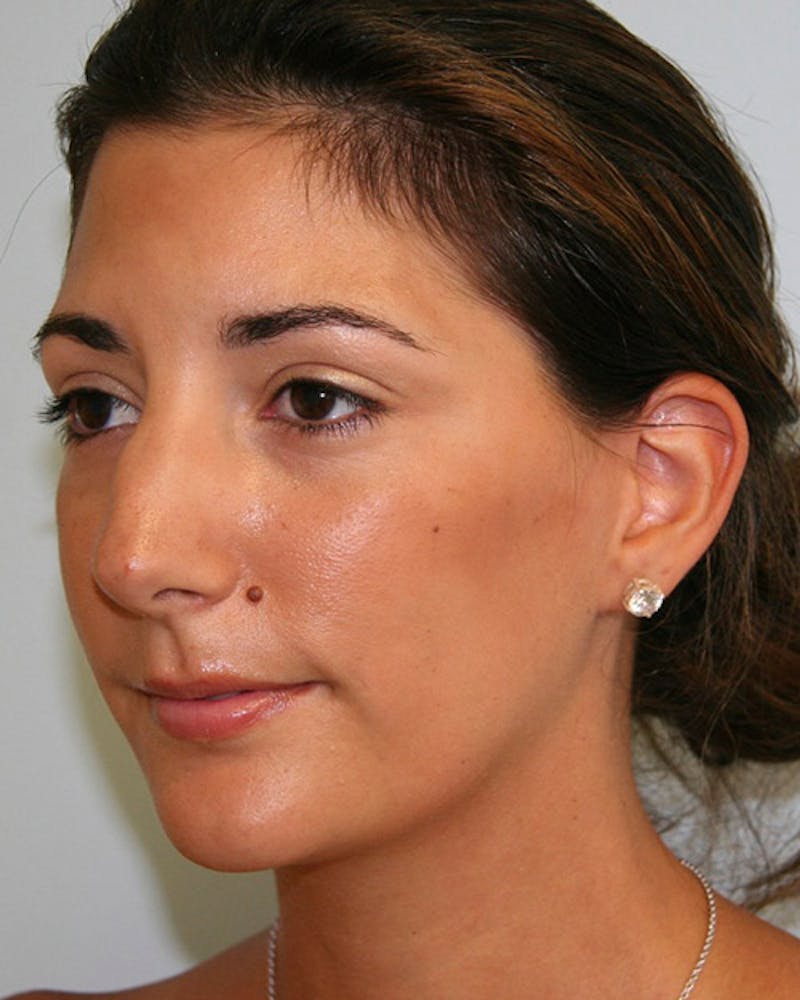 Rhinoplasty Before & After Gallery - Patient 143522118 - Image 3