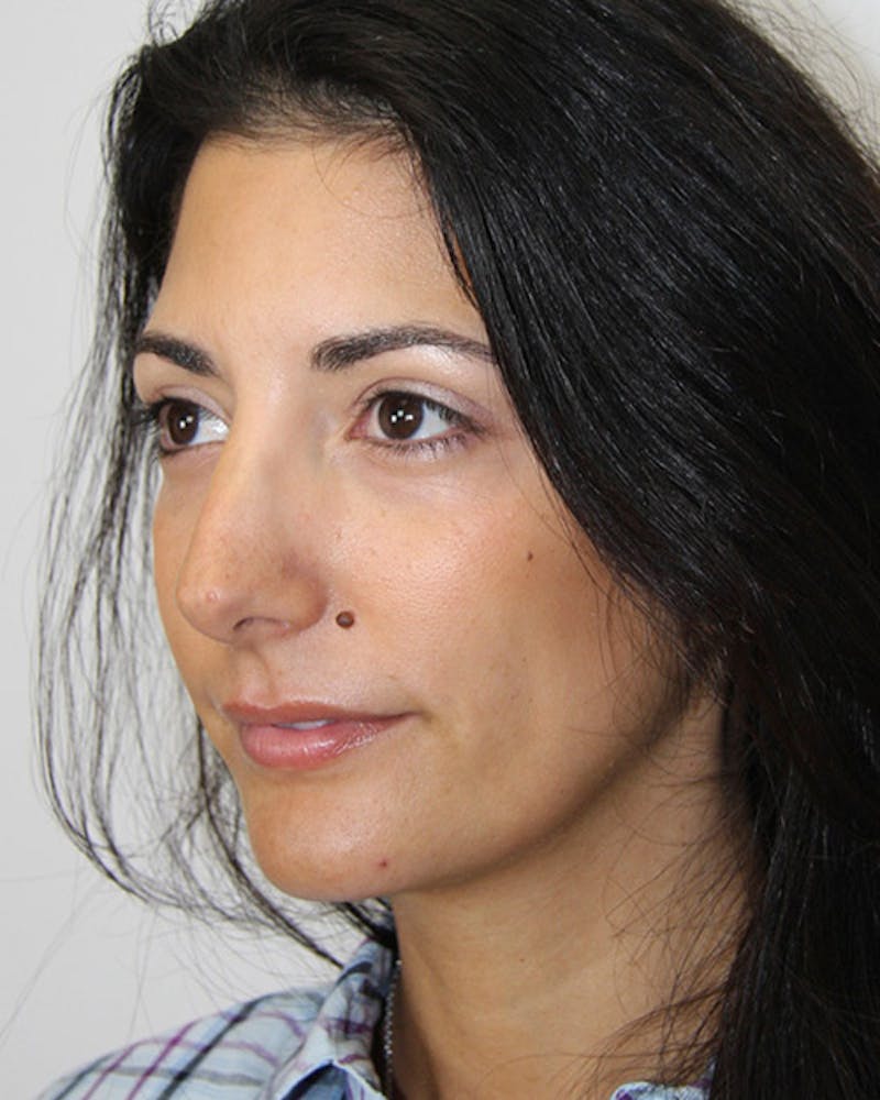 Rhinoplasty Before & After Gallery - Patient 143522118 - Image 4