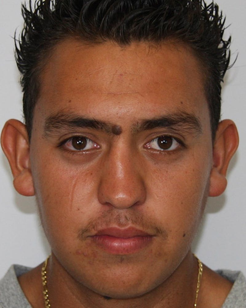 Rhinoplasty Before & After Gallery - Patient 143522120 - Image 1