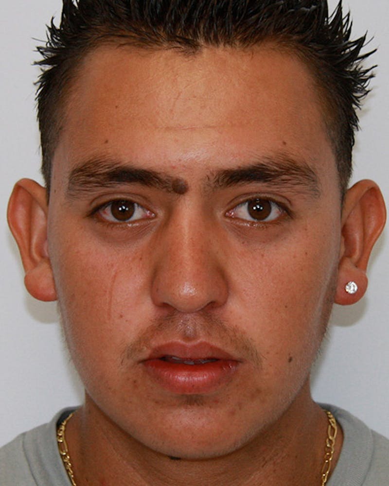 Rhinoplasty Before & After Gallery - Patient 143522120 - Image 2