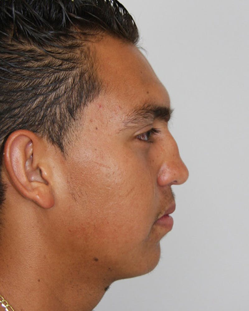 Rhinoplasty Before & After Gallery - Patient 143522120 - Image 3