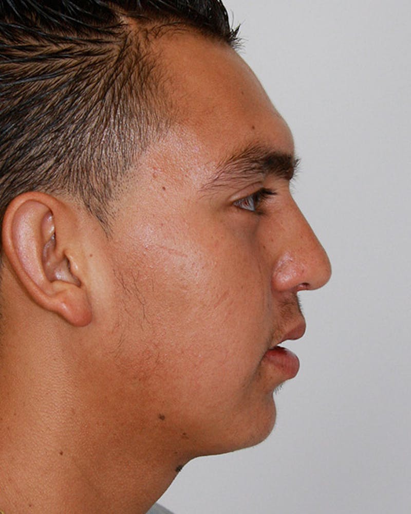 Rhinoplasty Before & After Gallery - Patient 143522120 - Image 4