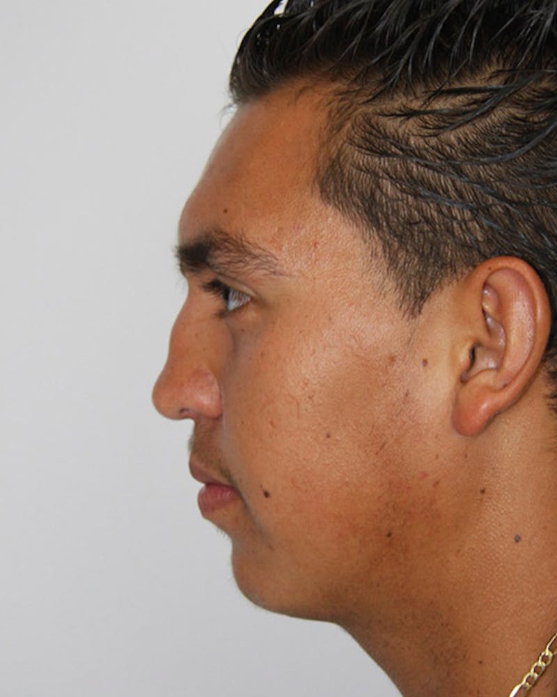 Rhinoplasty Before & After Gallery - Patient 143522120 - Image 5