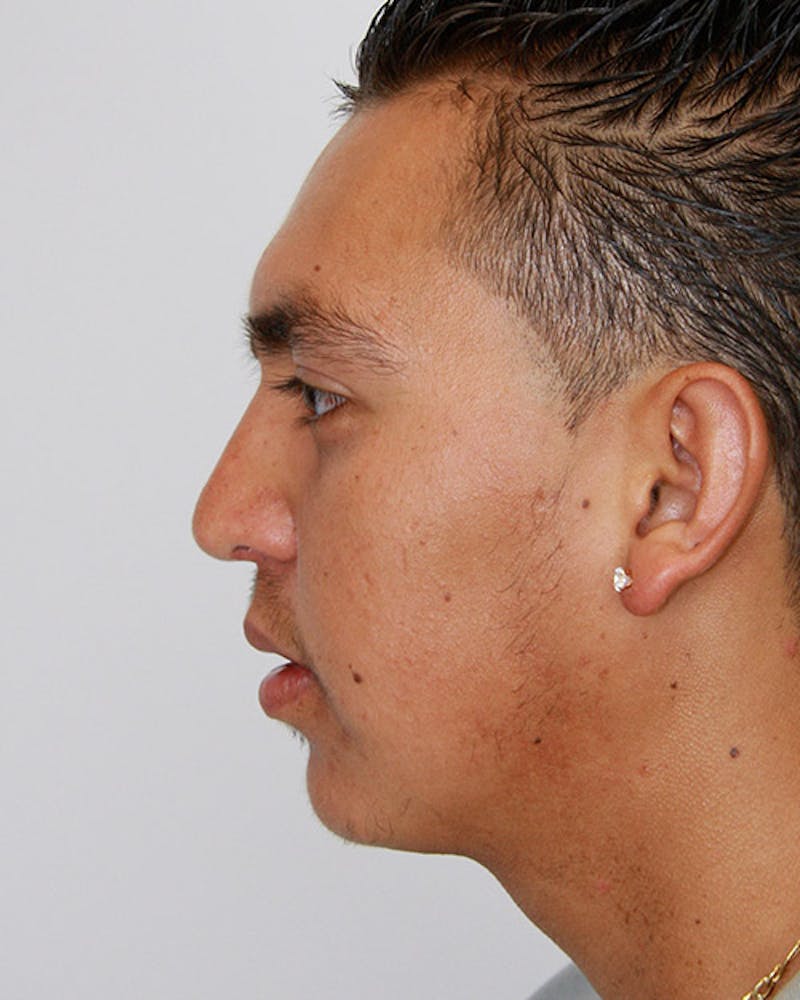 Rhinoplasty Before & After Gallery - Patient 143522120 - Image 6