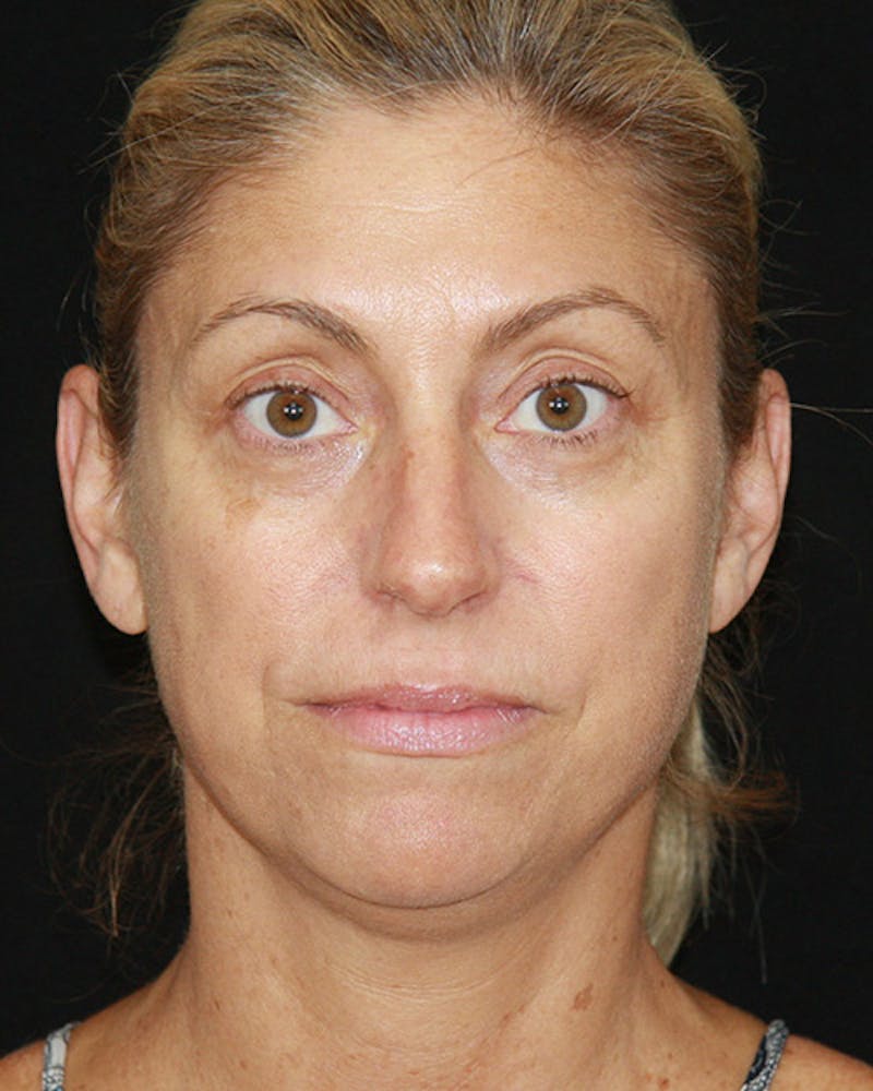 Rhinoplasty Before & After Gallery - Patient 143522123 - Image 1