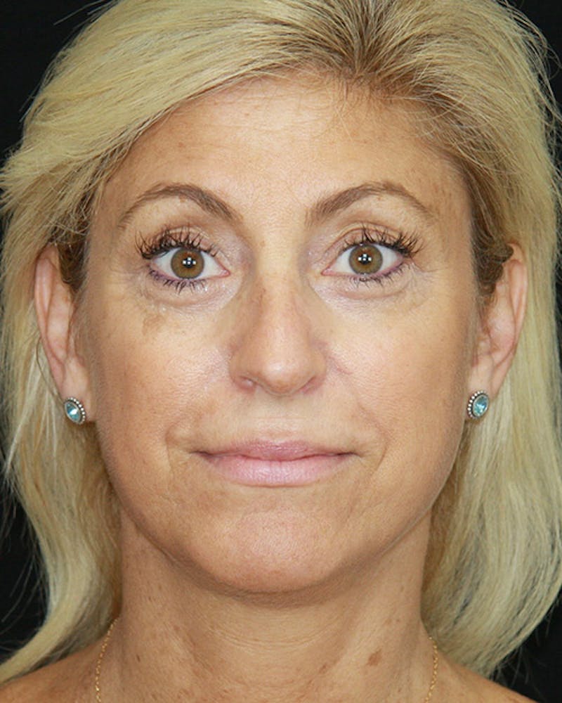 Rhinoplasty Before & After Gallery - Patient 143522123 - Image 2