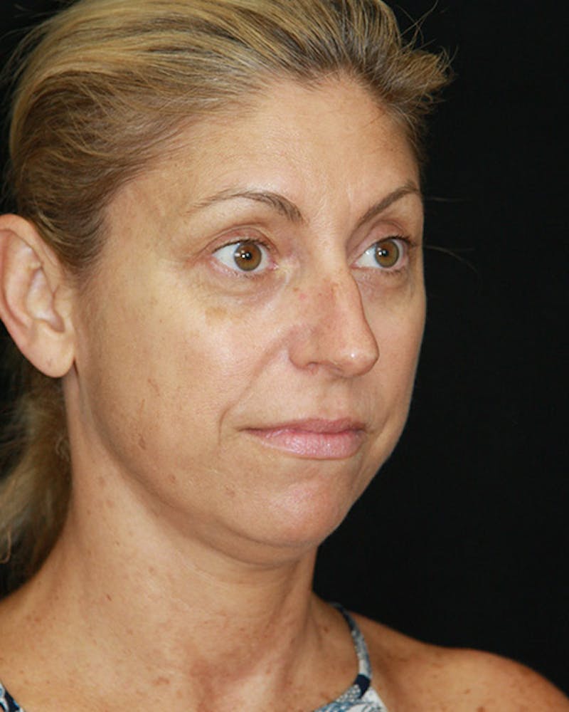 Rhinoplasty Before & After Gallery - Patient 143522123 - Image 3