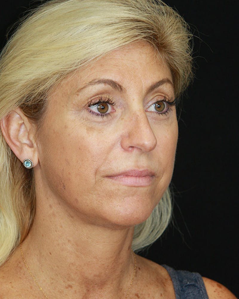 Rhinoplasty Before & After Gallery - Patient 143522123 - Image 4