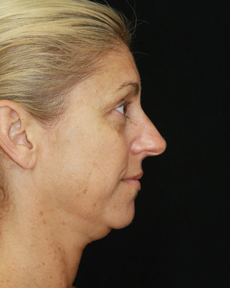 Rhinoplasty Before & After Gallery - Patient 143522123 - Image 5