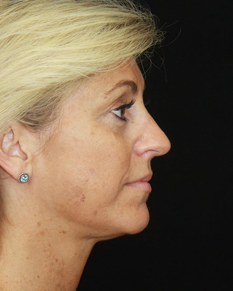 Rhinoplasty Before & After Gallery - Patient 143522123 - Image 6