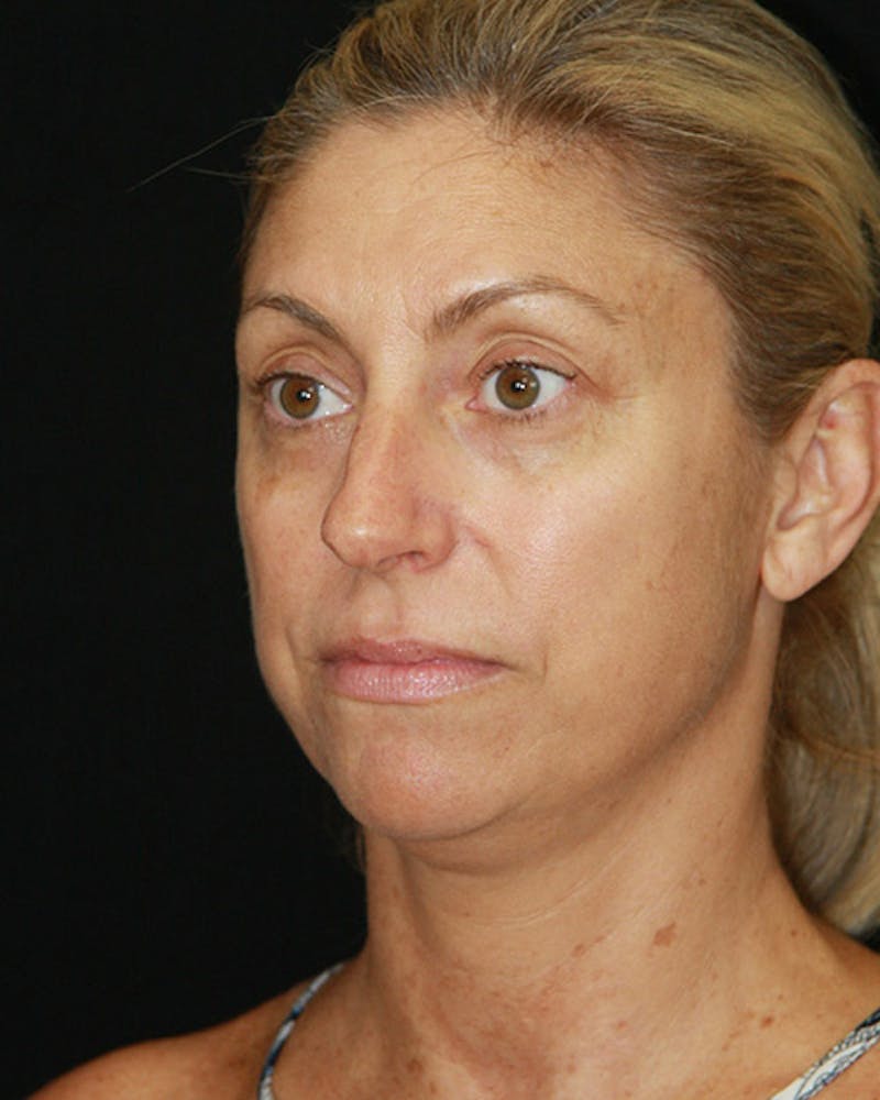 Rhinoplasty Before & After Gallery - Patient 143522123 - Image 7