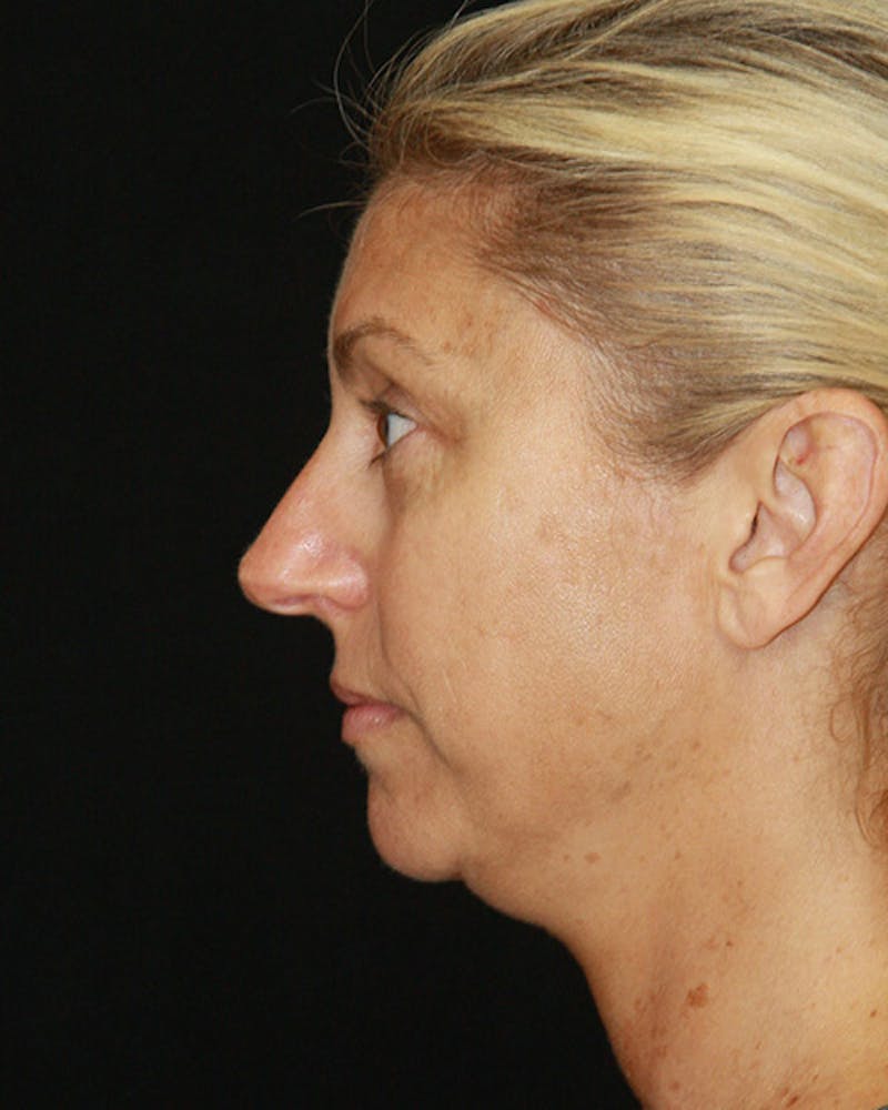 Rhinoplasty Before & After Gallery - Patient 143522123 - Image 9