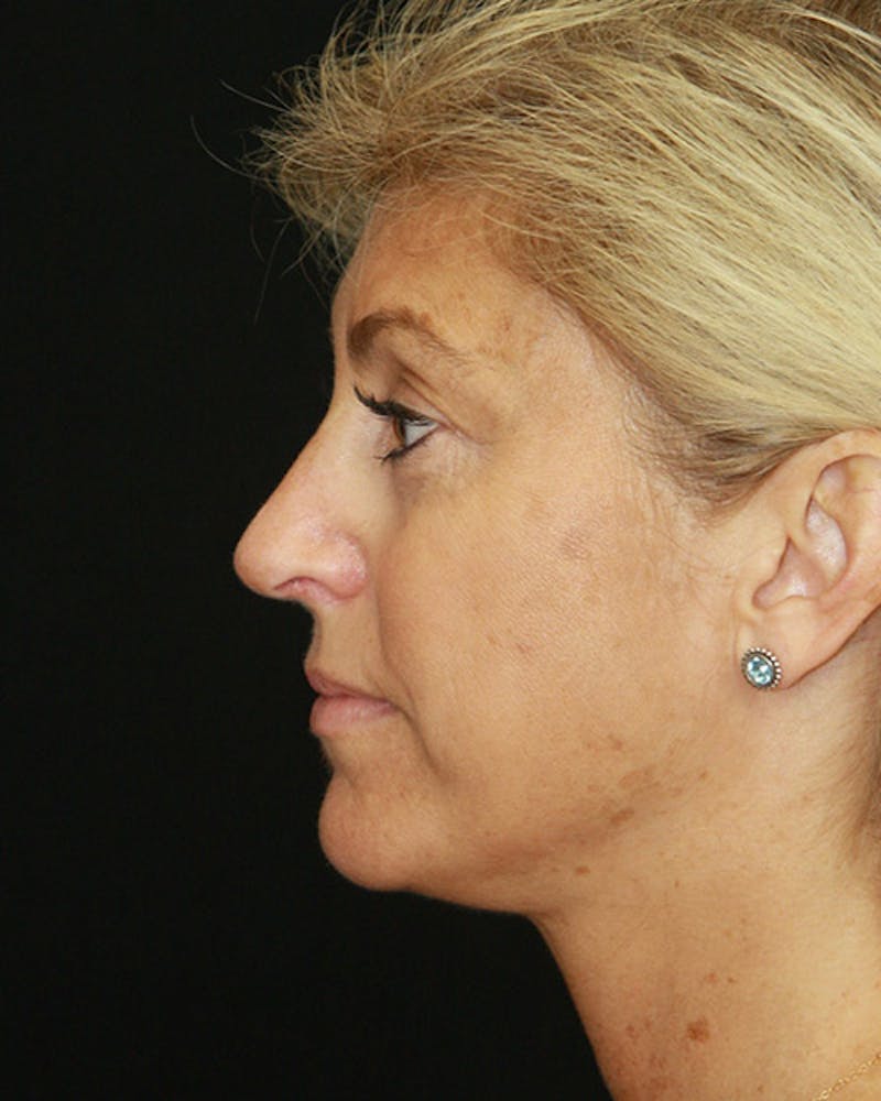 Rhinoplasty Before & After Gallery - Patient 143522123 - Image 10