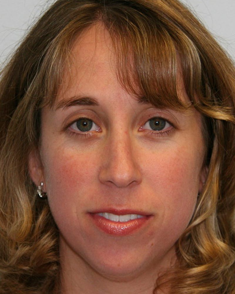 Rhinoplasty Before & After Gallery - Patient 143522124 - Image 2