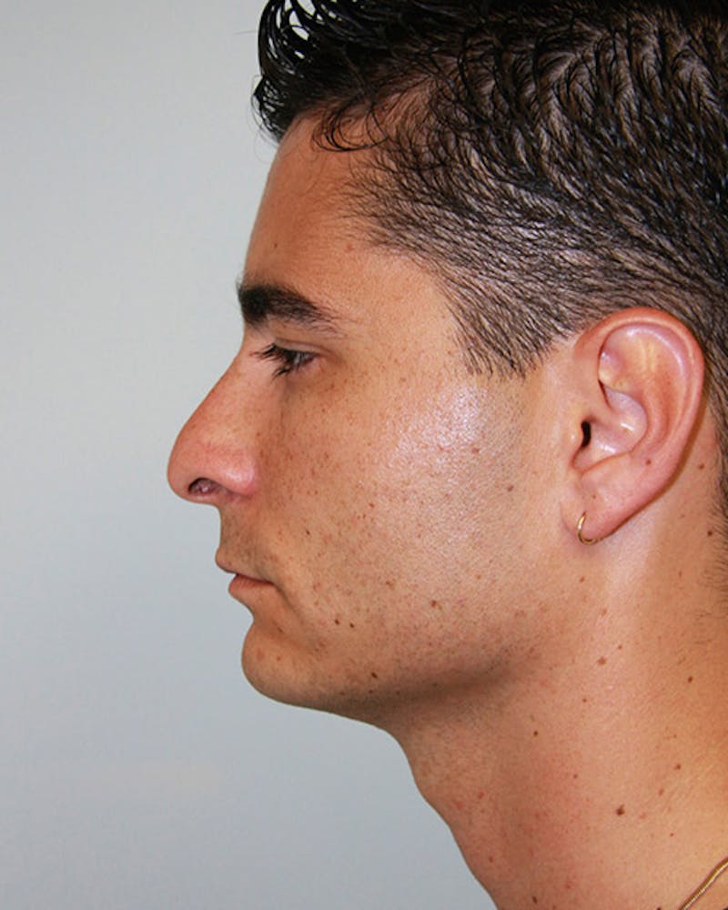 Rhinoplasty Before & After Gallery - Patient 143522125 - Image 1
