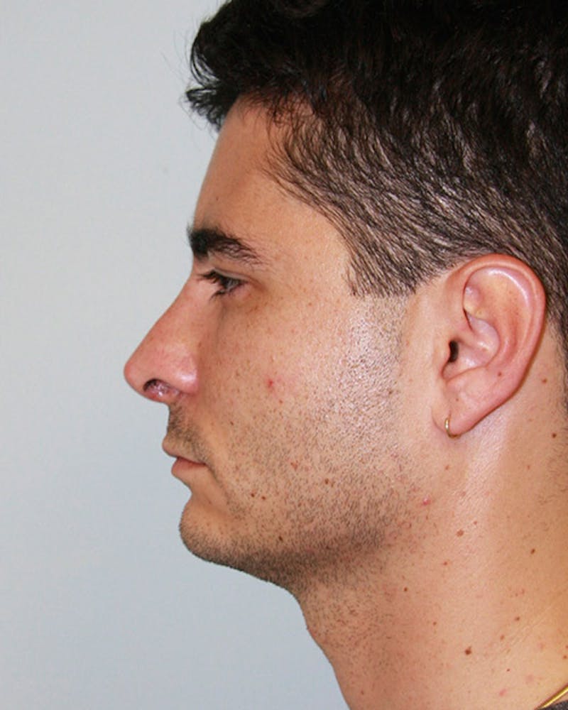 Rhinoplasty Before & After Gallery - Patient 143522125 - Image 2