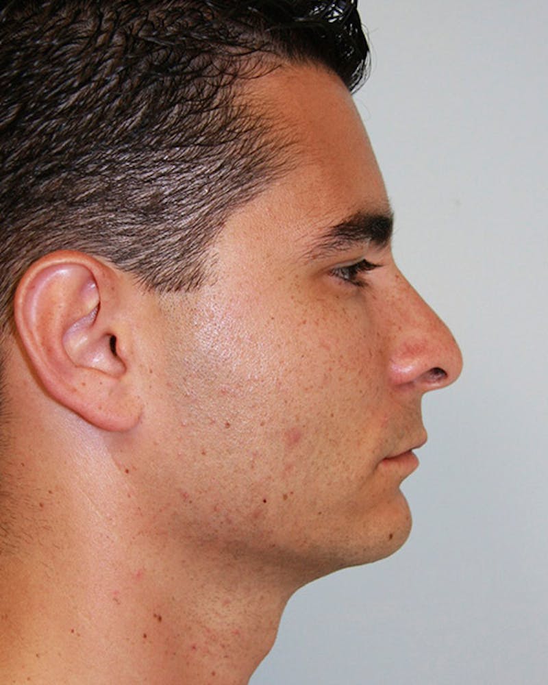 Rhinoplasty Before & After Gallery - Patient 143522125 - Image 3