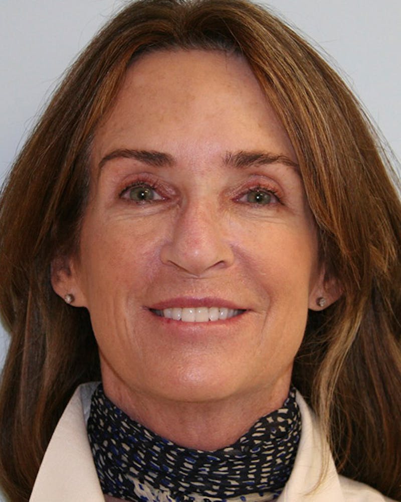 Rhinoplasty Before & After Gallery - Patient 143522132 - Image 1