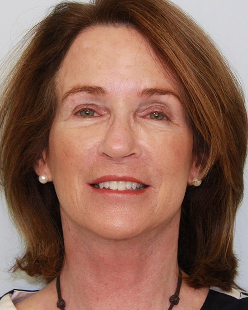 Rhinoplasty Before & After Gallery - Patient 143522132 - Image 2