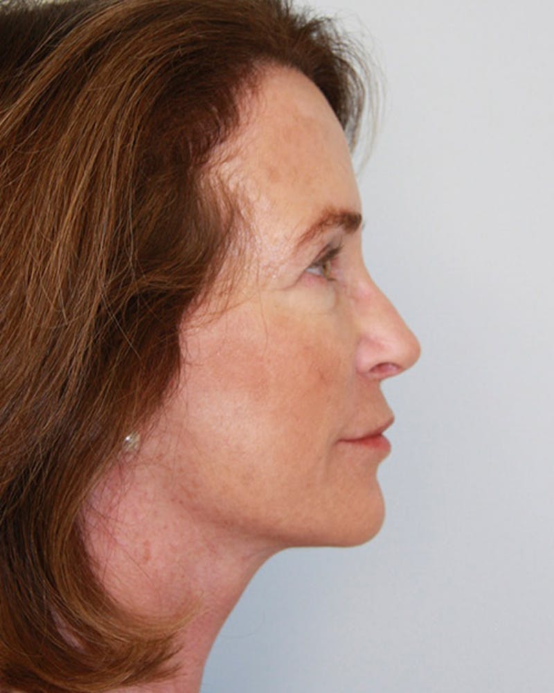 Rhinoplasty Before & After Gallery - Patient 143522132 - Image 4