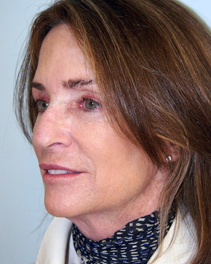 Rhinoplasty Before & After Gallery - Patient 143522132 - Image 7