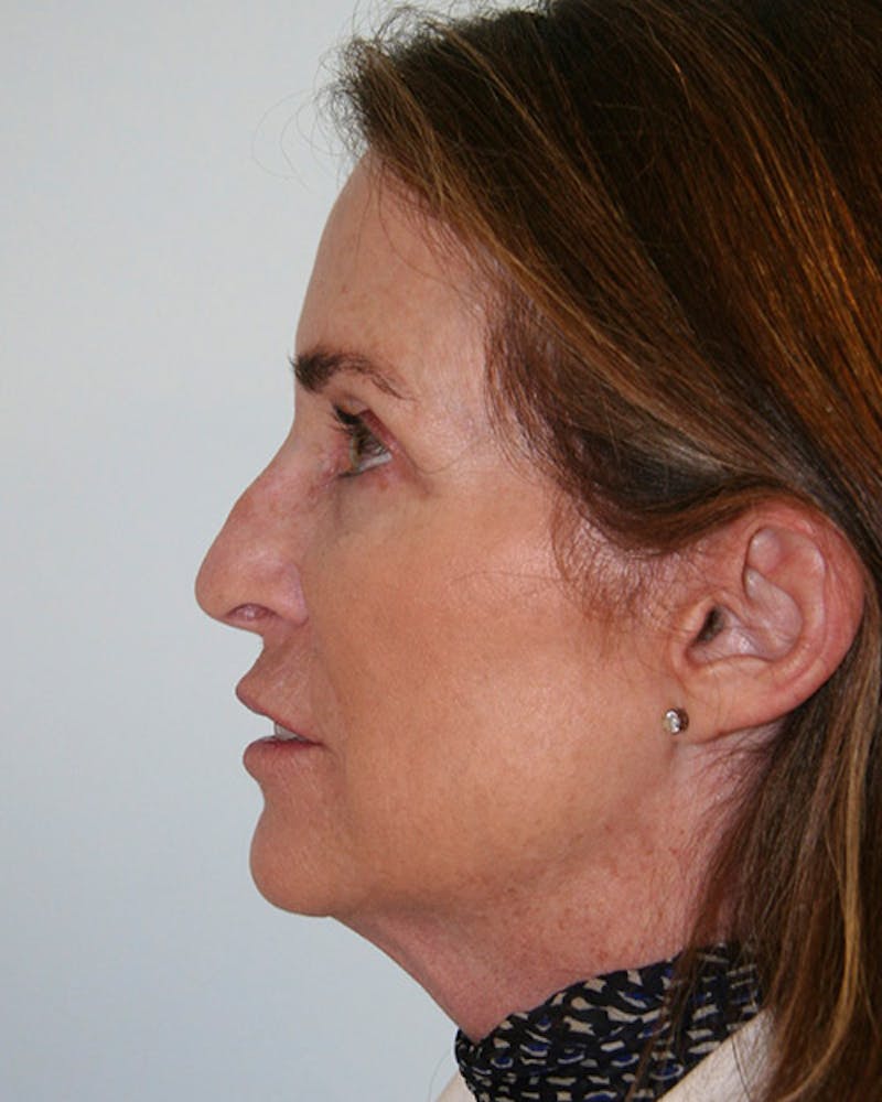 Rhinoplasty Before & After Gallery - Patient 143522132 - Image 9