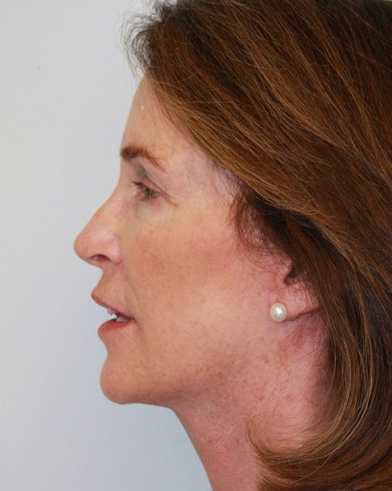 Rhinoplasty Before & After Gallery - Patient 143522132 - Image 10