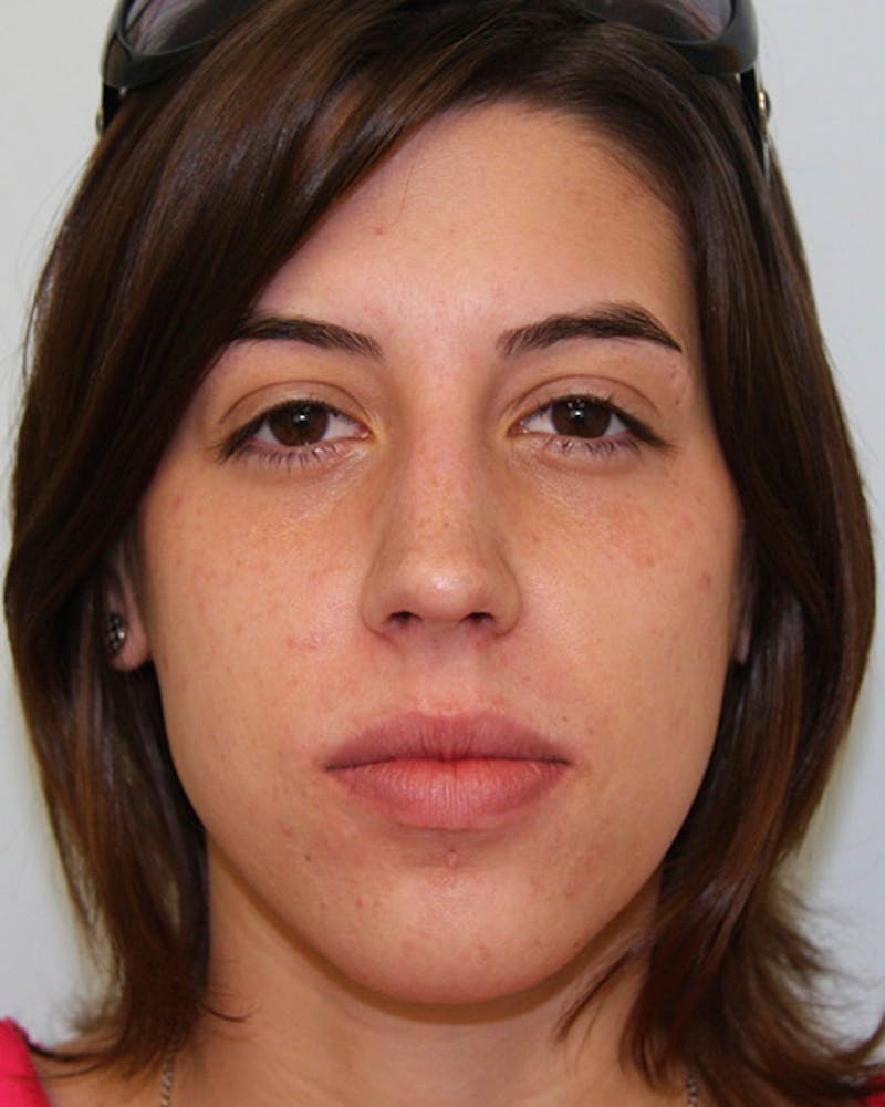 Rhinoplasty Before & After Gallery - Patient 143522135 - Image 1