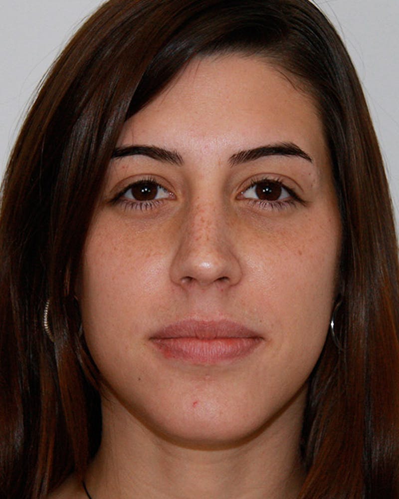 Rhinoplasty Before & After Gallery - Patient 143522135 - Image 2