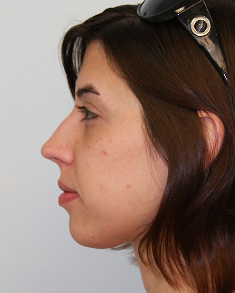 Rhinoplasty Before & After Gallery - Patient 143522135 - Image 3