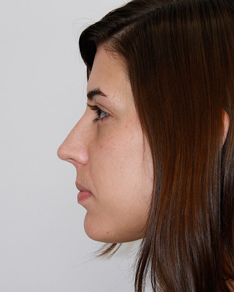 Rhinoplasty Before & After Gallery - Patient 143522135 - Image 4