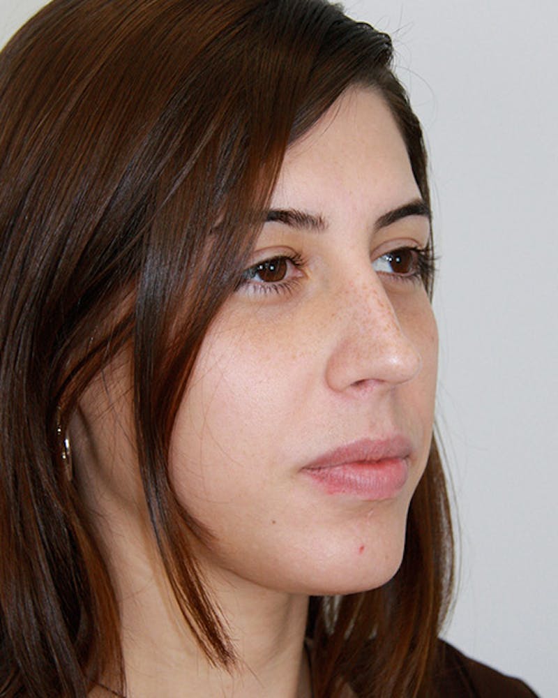 Rhinoplasty Before & After Gallery - Patient 143522135 - Image 6