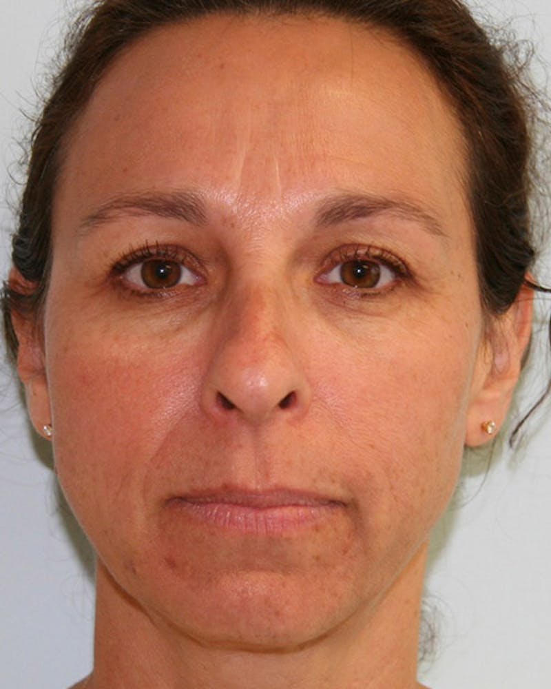Rhinoplasty Before & After Gallery - Patient 143522137 - Image 1