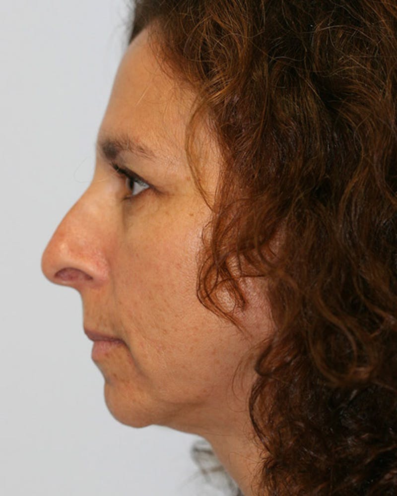 Rhinoplasty Before & After Gallery - Patient 143522137 - Image 3
