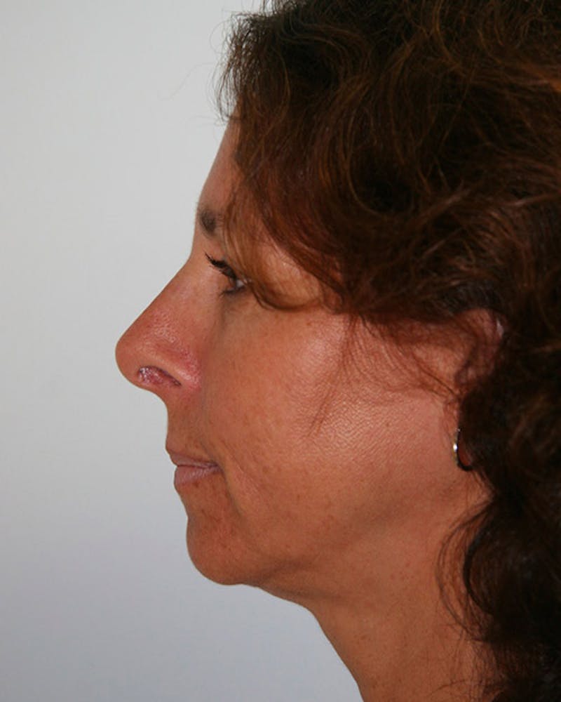Rhinoplasty Before & After Gallery - Patient 143522137 - Image 4