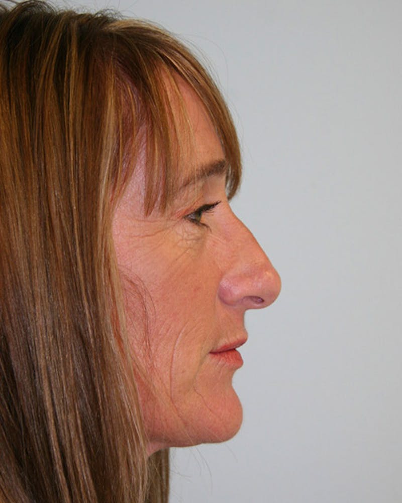 Rhinoplasty Before & After Gallery - Patient 143522138 - Image 1