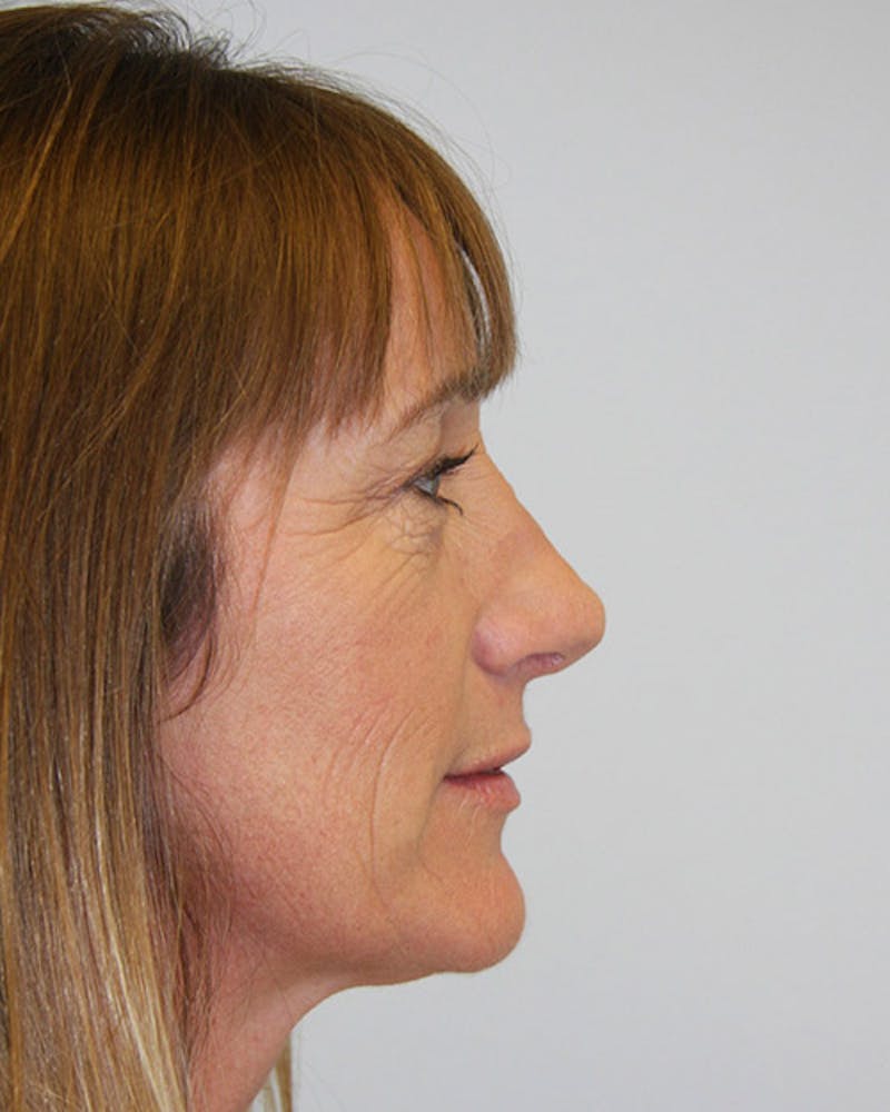 Rhinoplasty Before & After Gallery - Patient 143522138 - Image 2