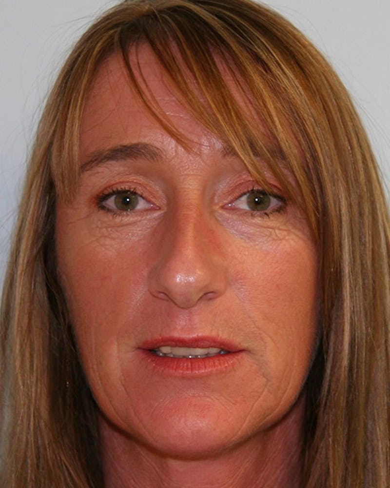 Rhinoplasty Before & After Gallery - Patient 143522138 - Image 3