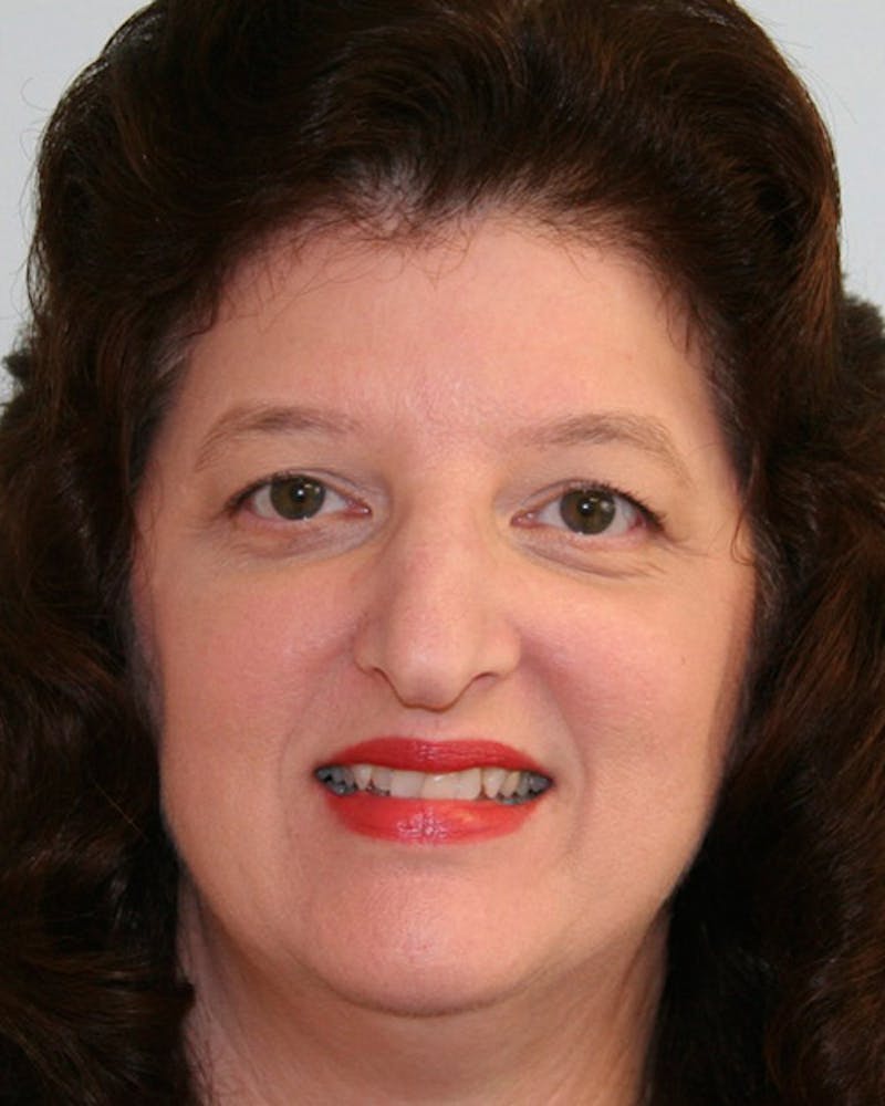 Rhinoplasty Before & After Gallery - Patient 143522140 - Image 1