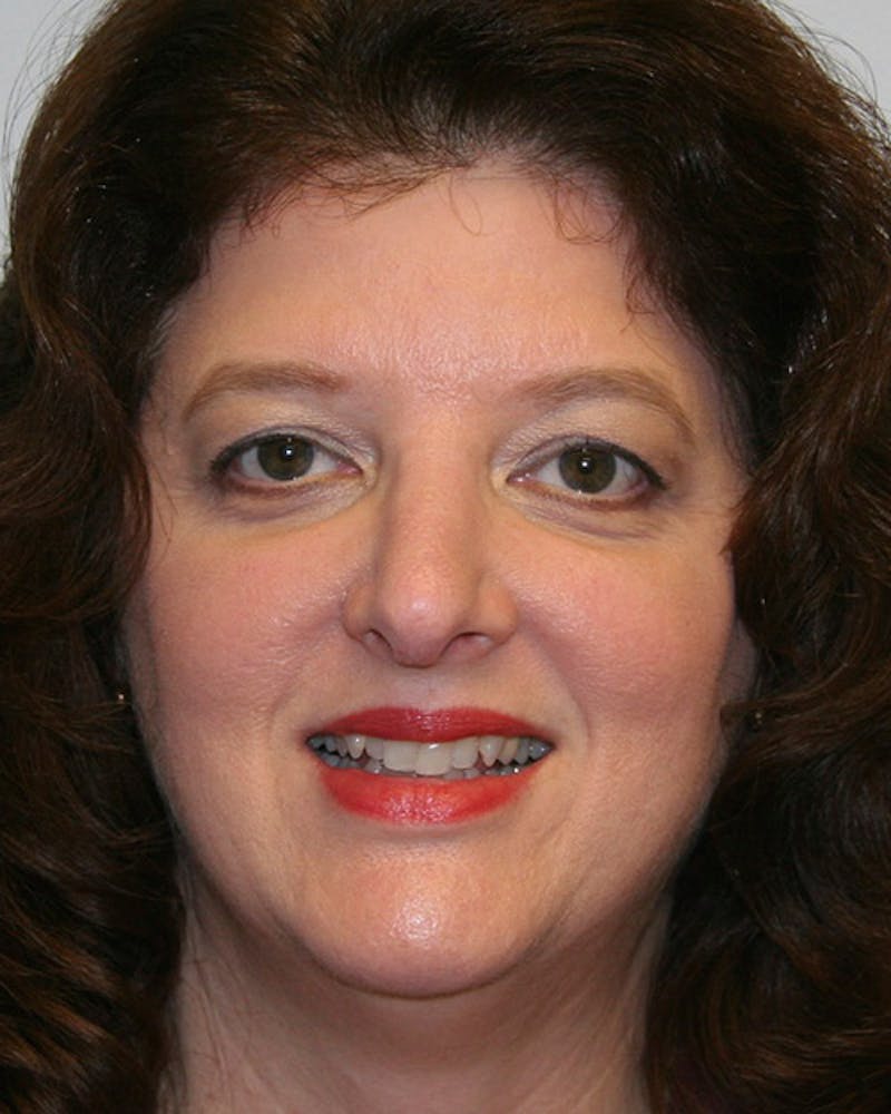 Rhinoplasty Before & After Gallery - Patient 143522140 - Image 2