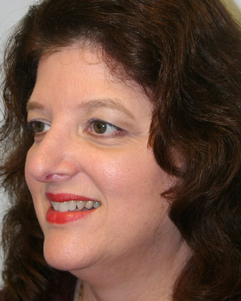 Rhinoplasty Before & After Gallery - Patient 143522140 - Image 4