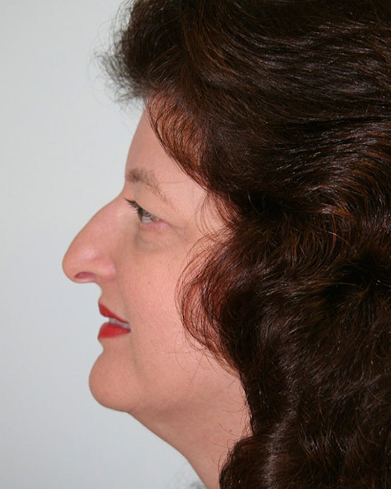 Rhinoplasty Before & After Gallery - Patient 143522140 - Image 5