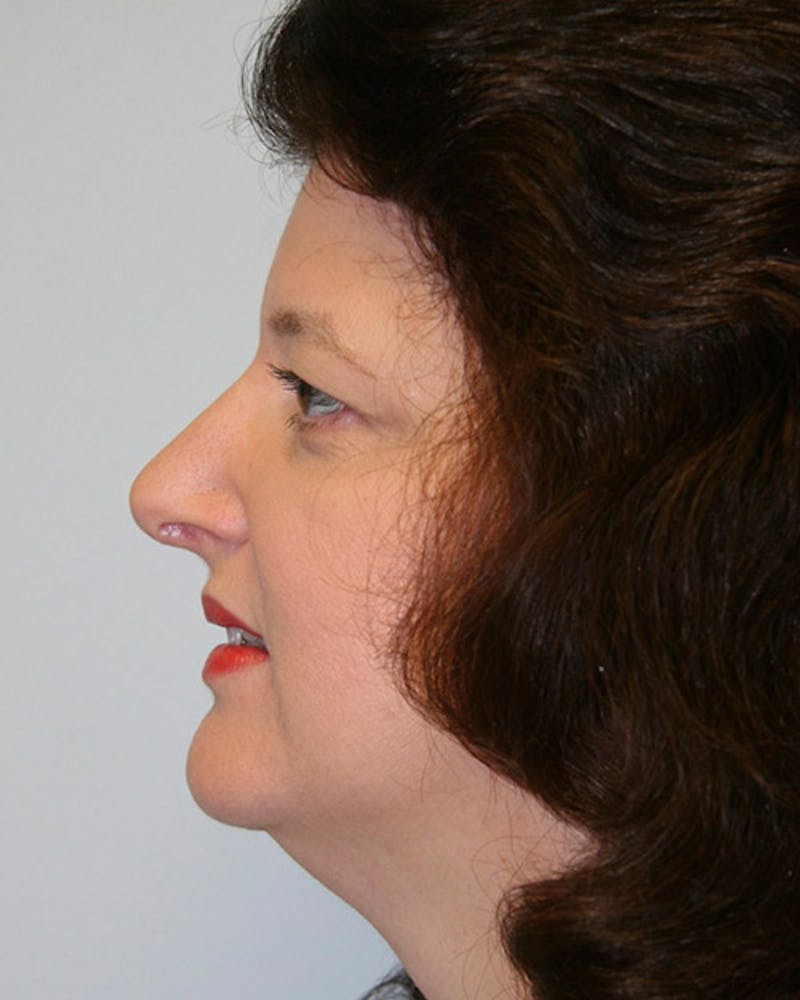 Rhinoplasty Before & After Gallery - Patient 143522140 - Image 6